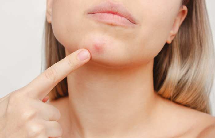 breakouts are red, swollen, and angry