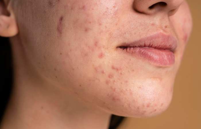 what acne-prone skin really means