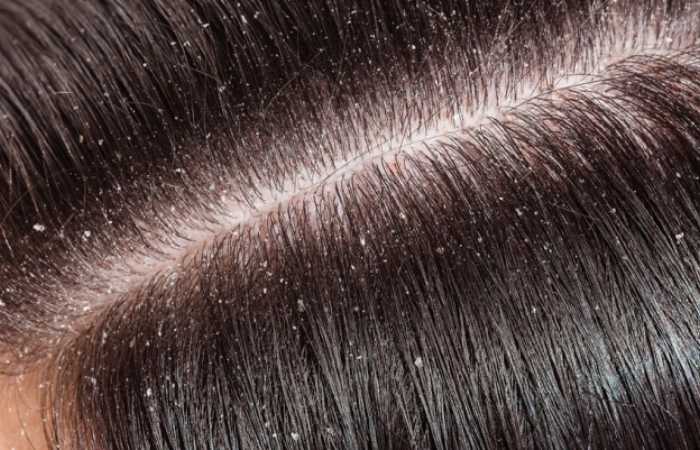 what exactly is dandruff