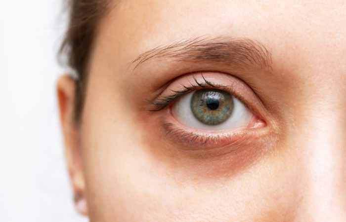 what are dark circles