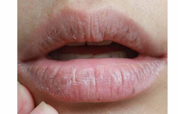 why do lips become dry