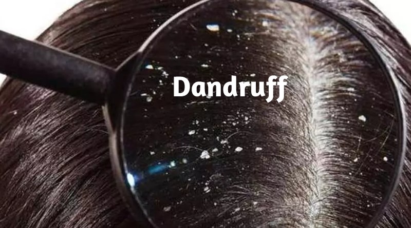 Dandruff - Neem Oil For Hair