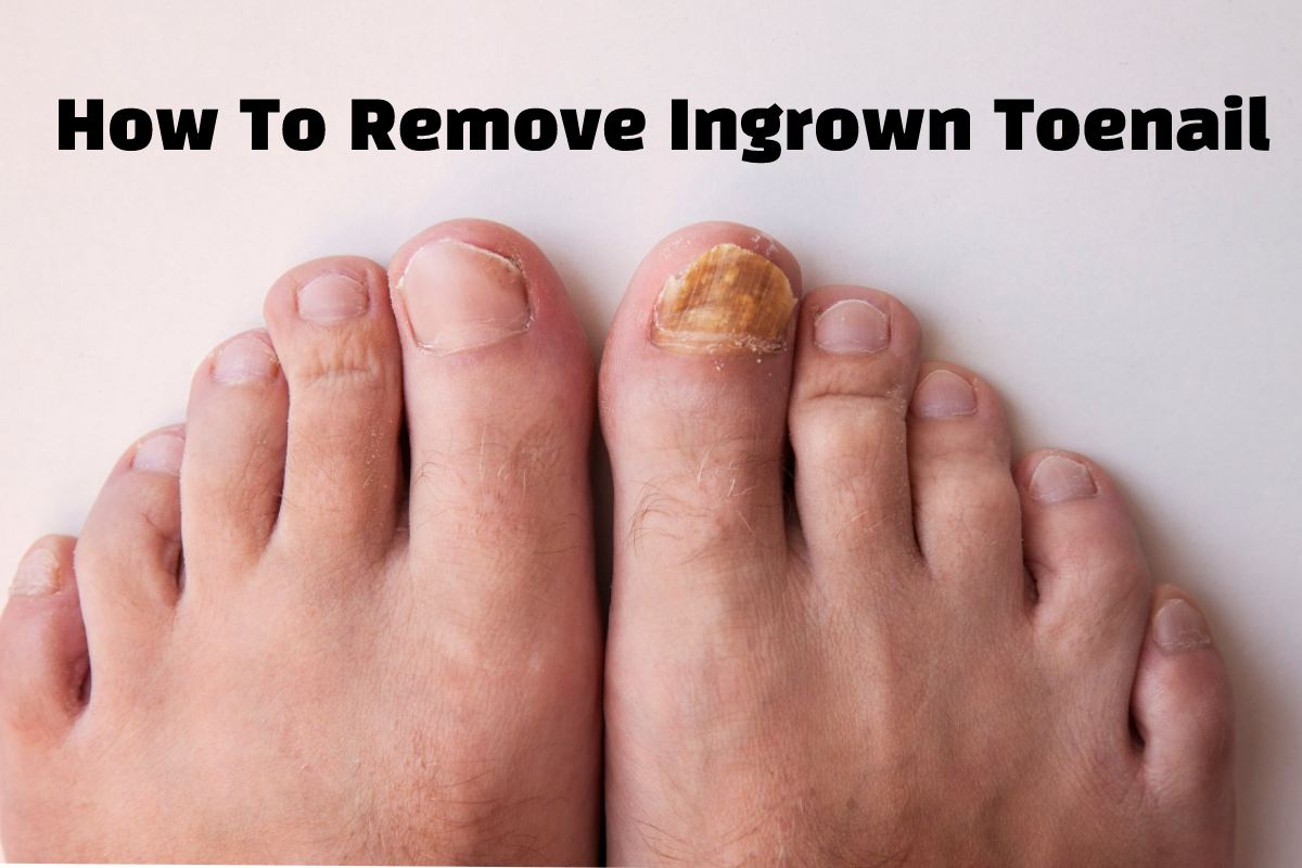 How To Remove Ingrown Toenail Step By Step Beautys Guide