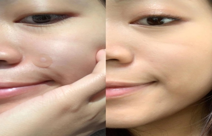 Pimple Patch Before And After