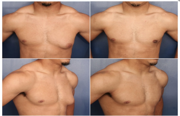 Gynecomastia Intervention