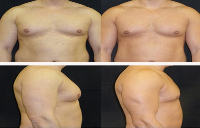 Types of Gynecomastia