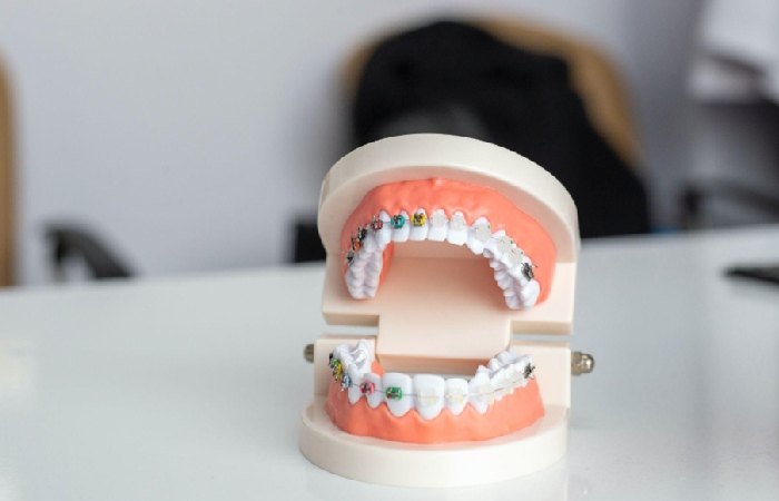 Traditional NHS orthodontists offer a range of conventional treatments such as: 