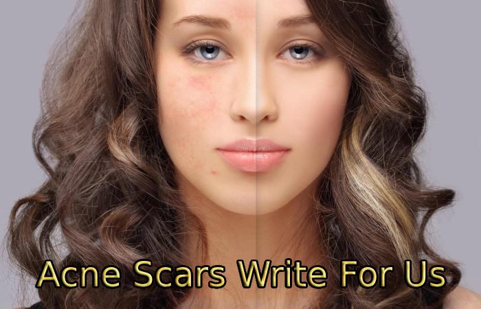 Acne Scars Write For Us