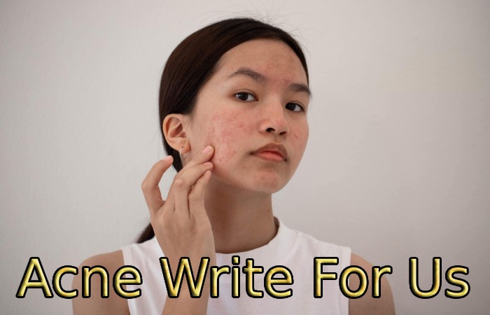 Acne Write For Us