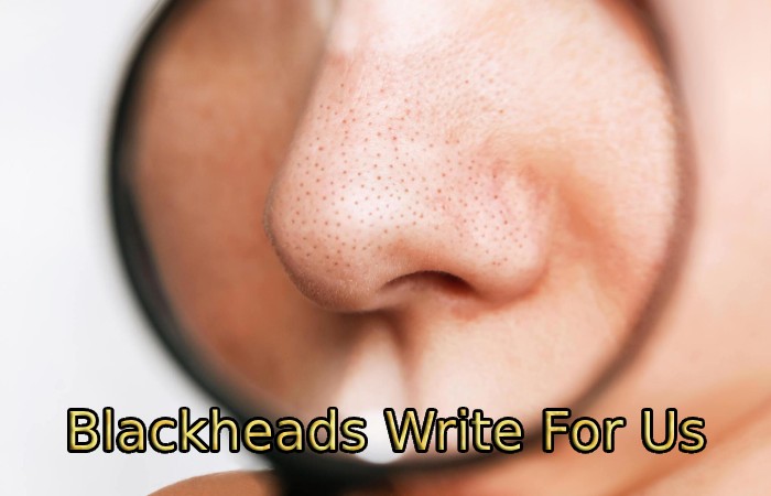 Blackheads Write For Us